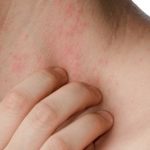 Pokrzywka na skórze – co to takiego i skąd się bierze?